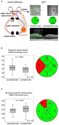 Retinal Changes After Posterior Cerebral Artery Infarctions Display Different Patterns of the Nasal und Temporal Sector in a Case Series